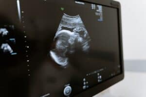 בדיקת אולטרסאונד -רשלנות רפואית בהריון
